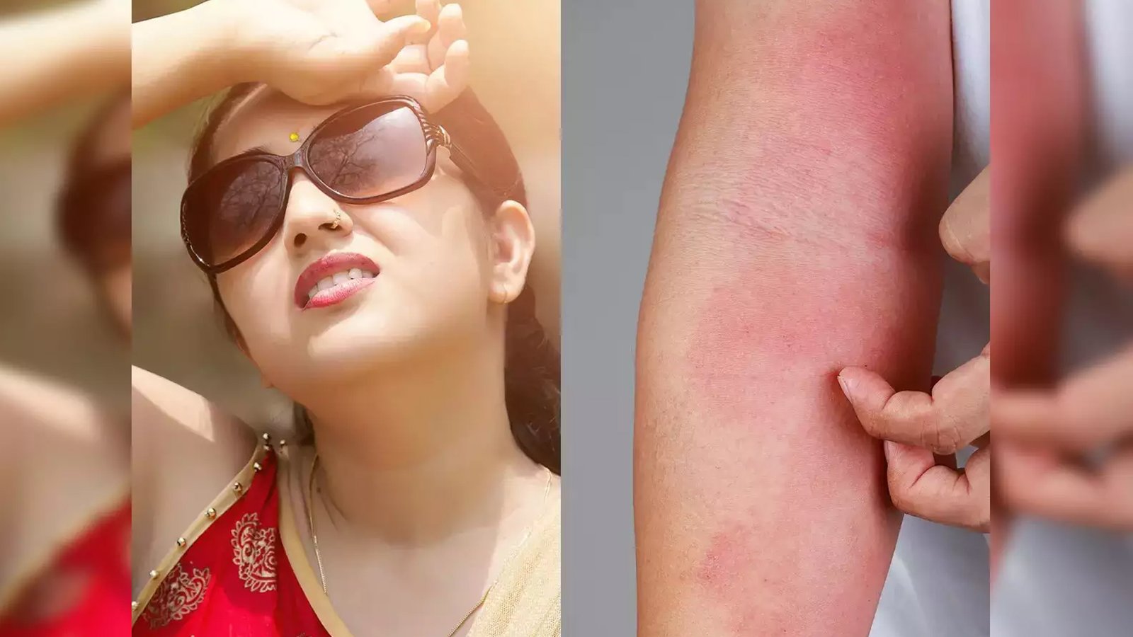 চর্ম এলার্জি চুলকানি